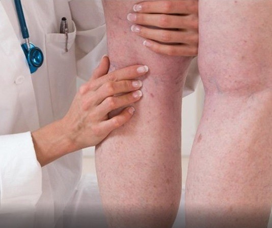 Campanha “Ame suas pernas” alerta para os riscos de trombose venosa