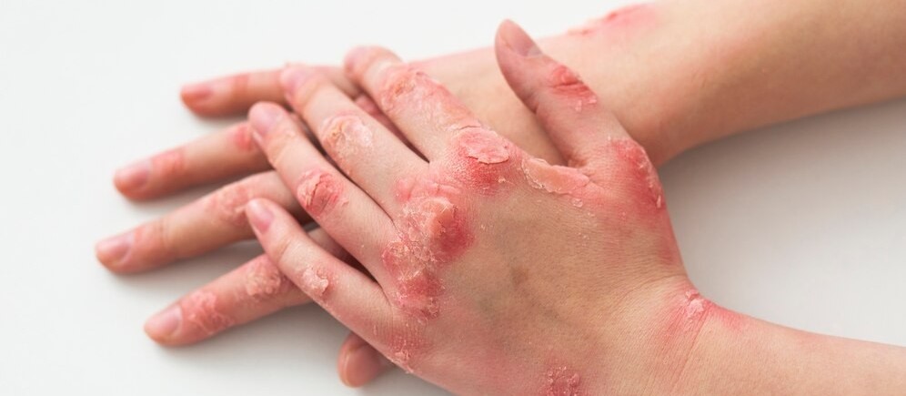 Psoríase e artrite psoriásica: qual a diferença?