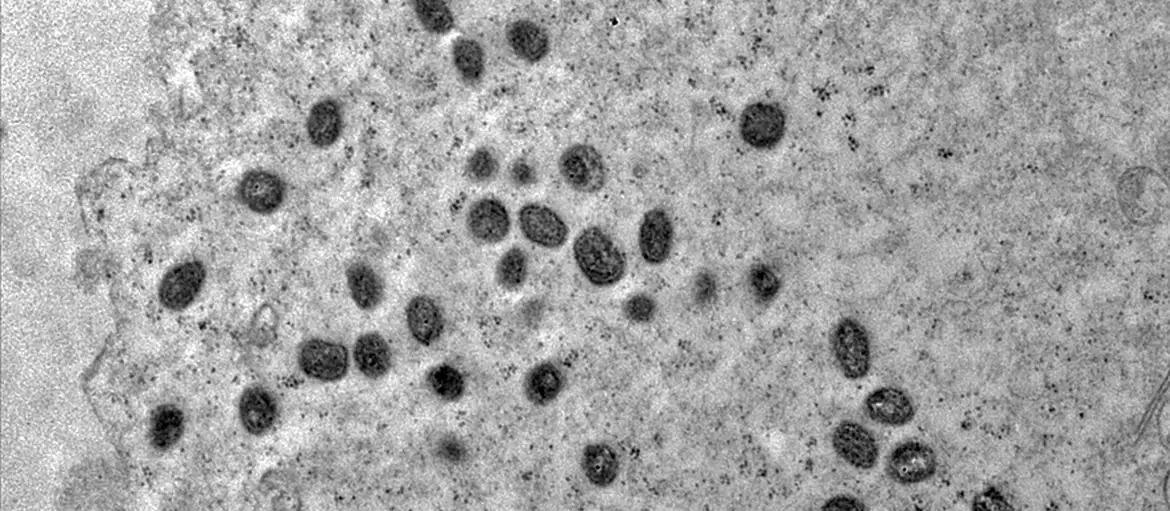 Saúde confirma primeiro caso de Mpox no Paraná em 2026