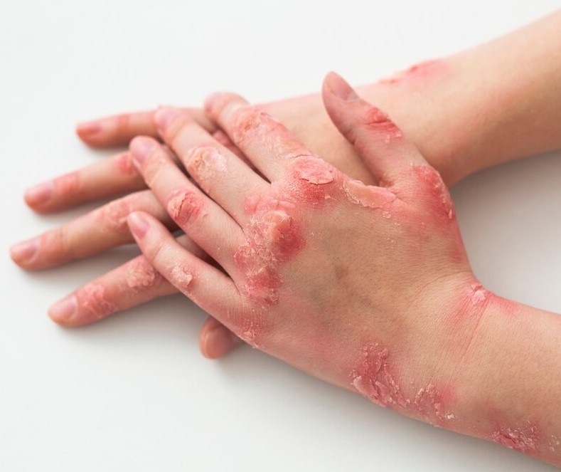 Psoríase e artrite psoriásica: qual a diferença?