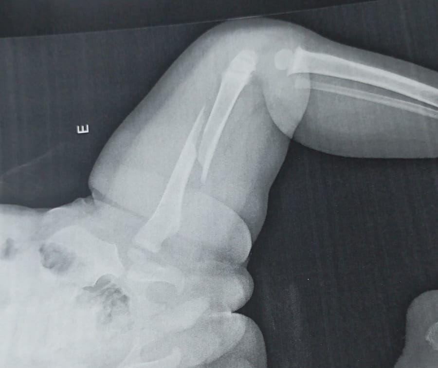 Avó de criança internada com fratura no fêmur relata desespero ao ver neto